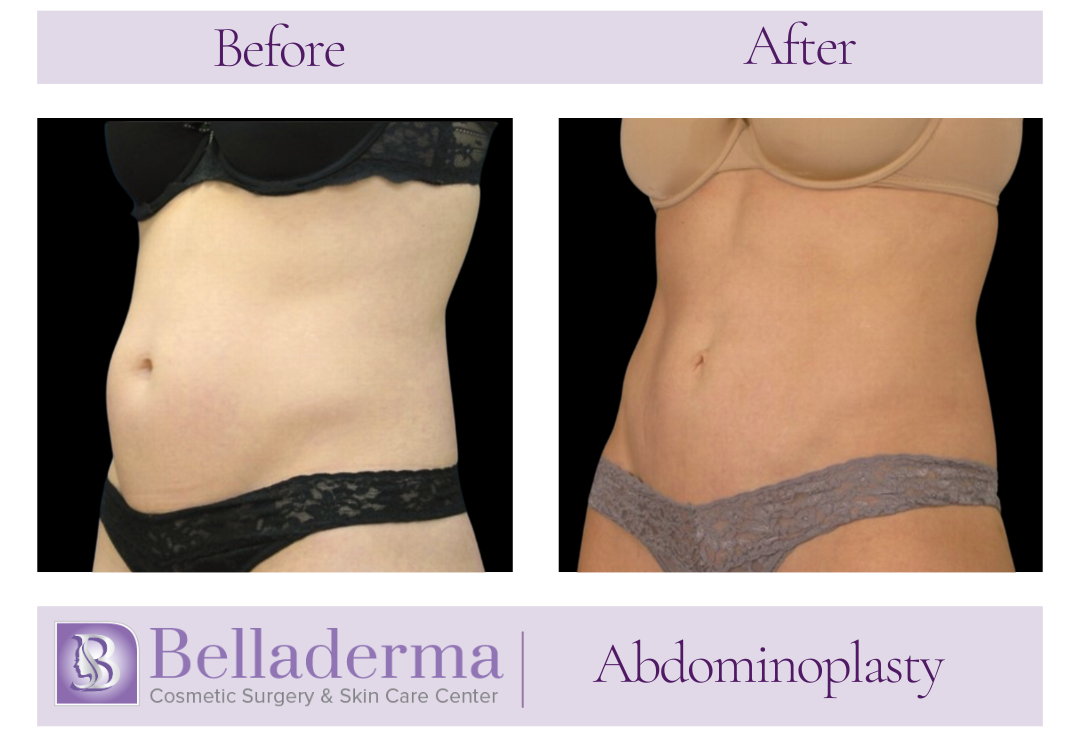 Feb wk 3 Tummy Tuck (abdominoplasty) Before and After