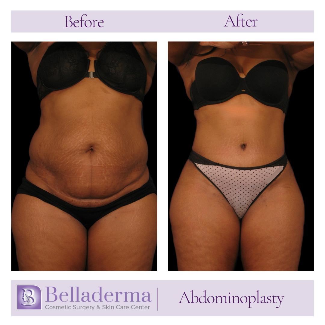 Tummy tuck