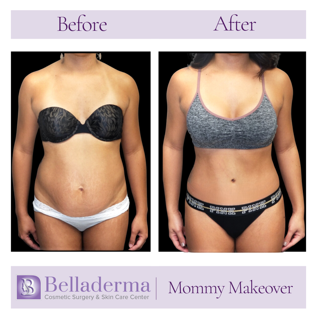 Mommy makeover