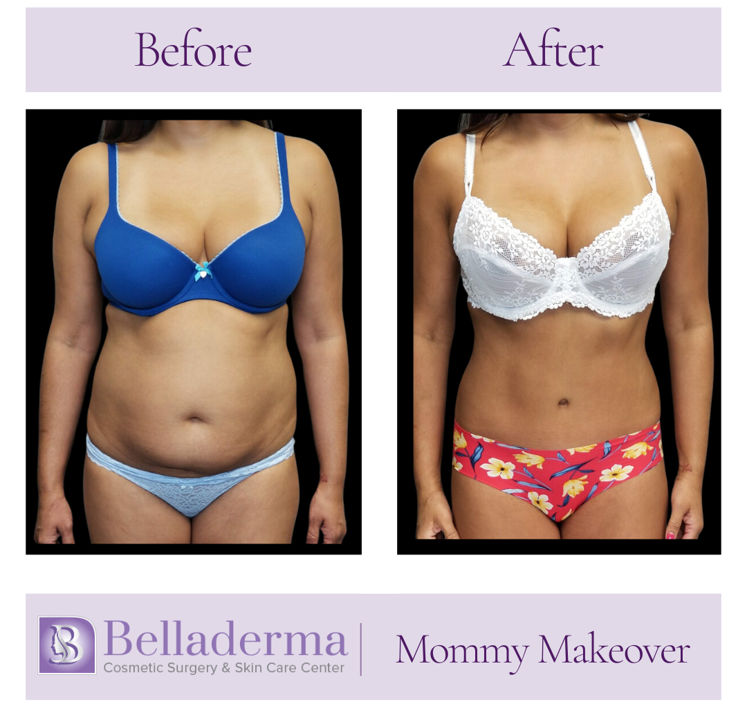 Mommy makeover