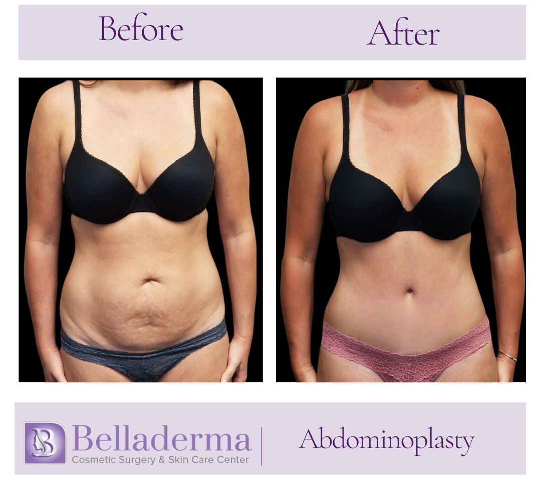 Tummy tuck