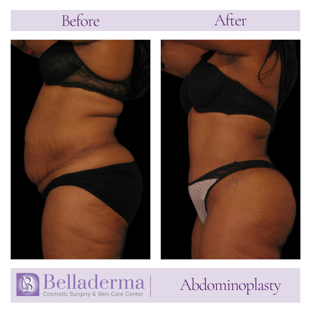 Tummy tuck