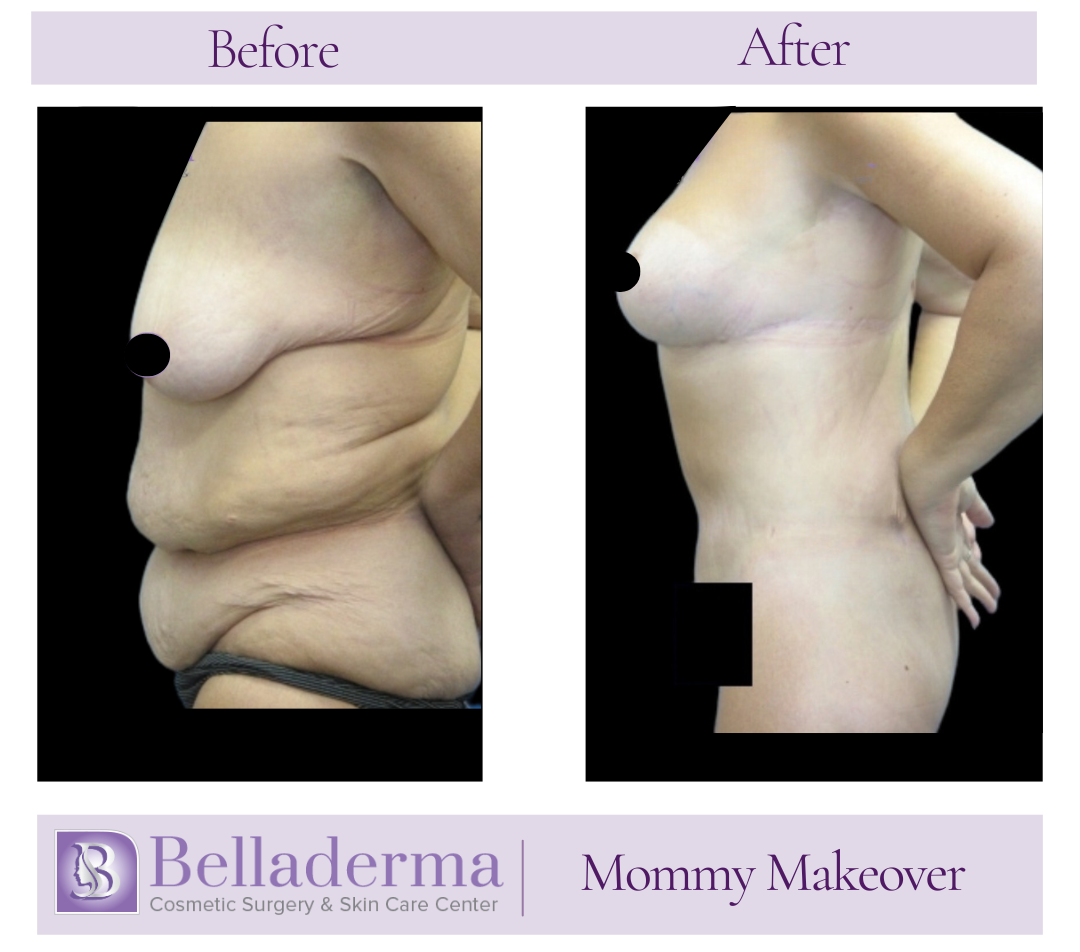 Mommy makeover