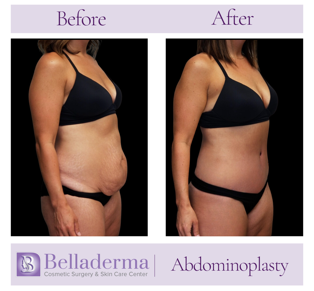 Tummy tuck