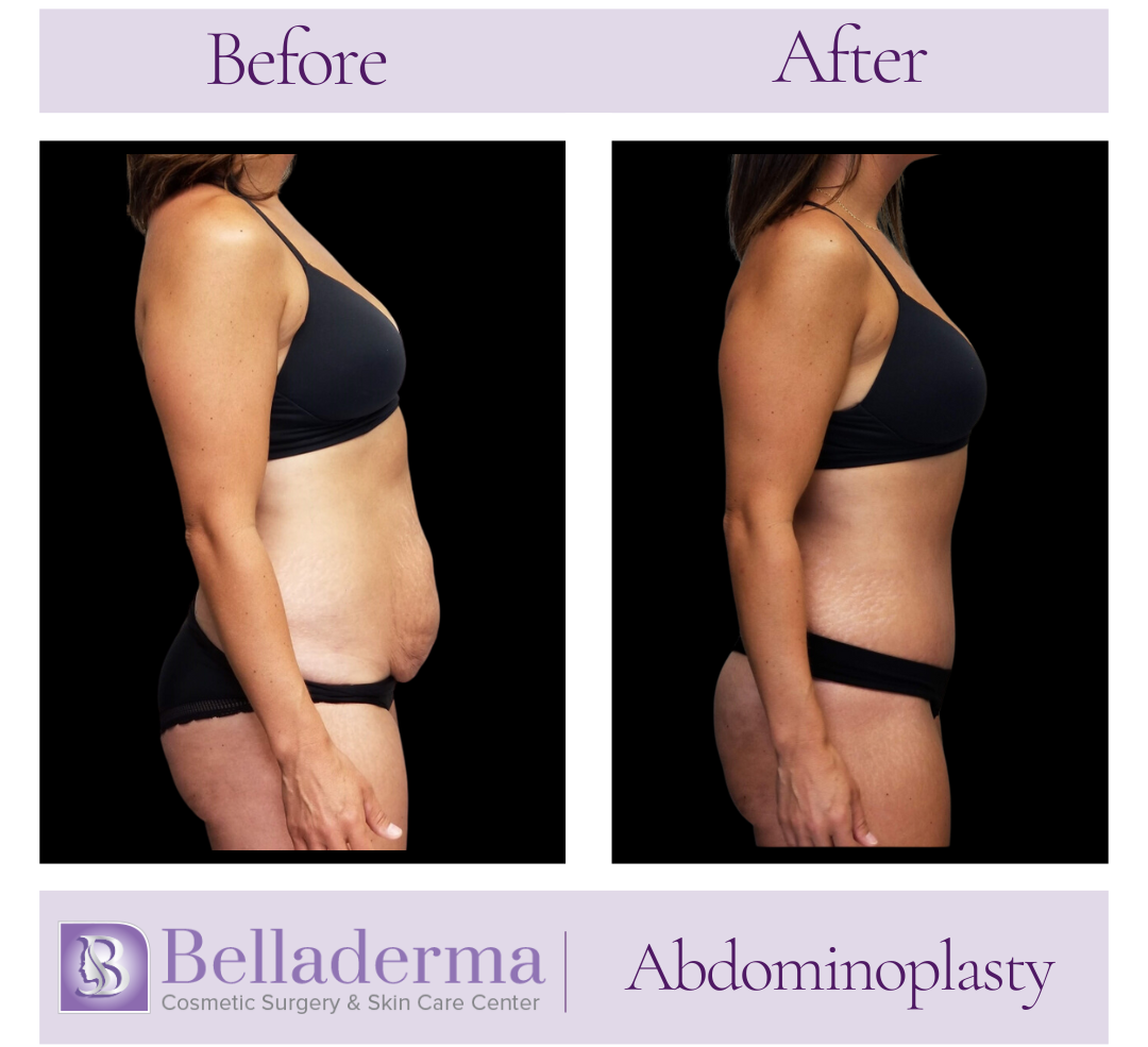 Tummy tuck