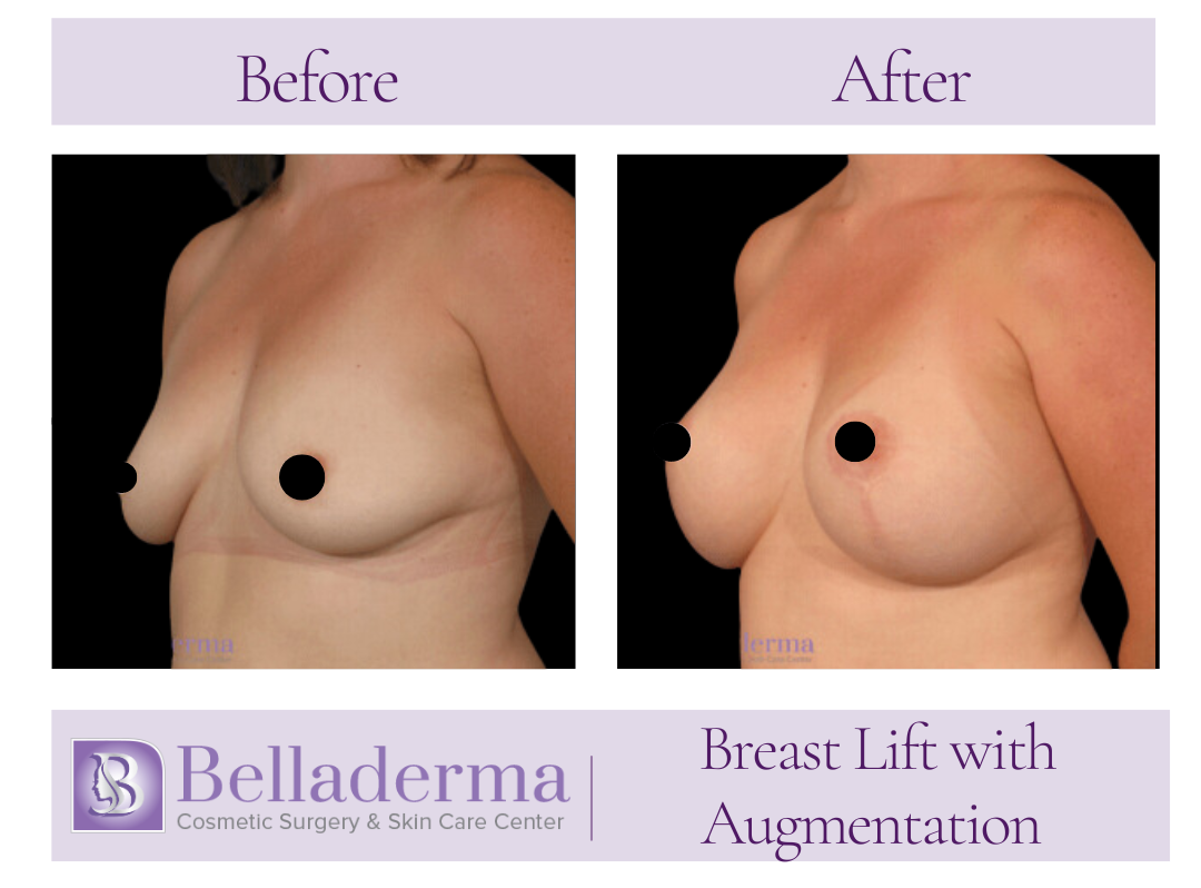 Augmentation with lift Breast Augmentation with Lift Before and After Photos