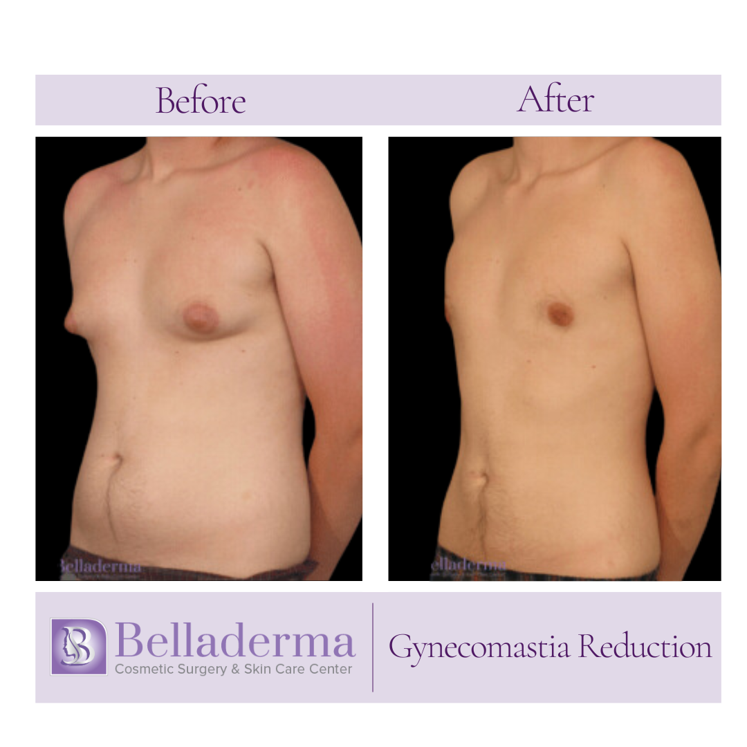 gynecomastia reduction
