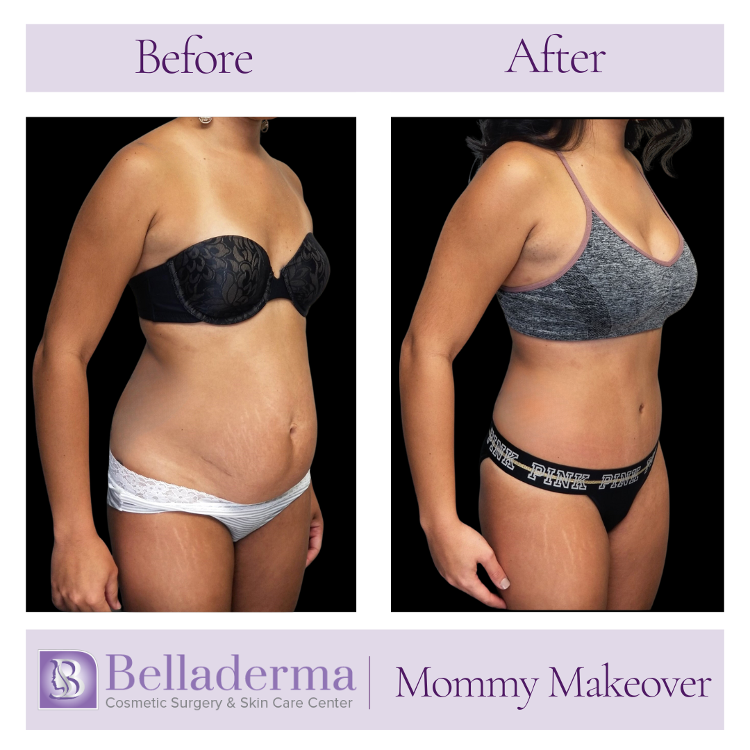 mommy makeover