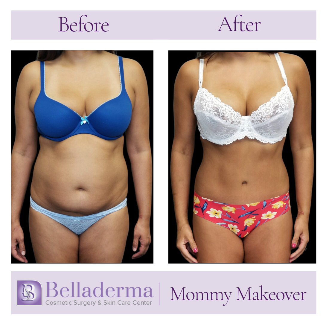 mommy makeover