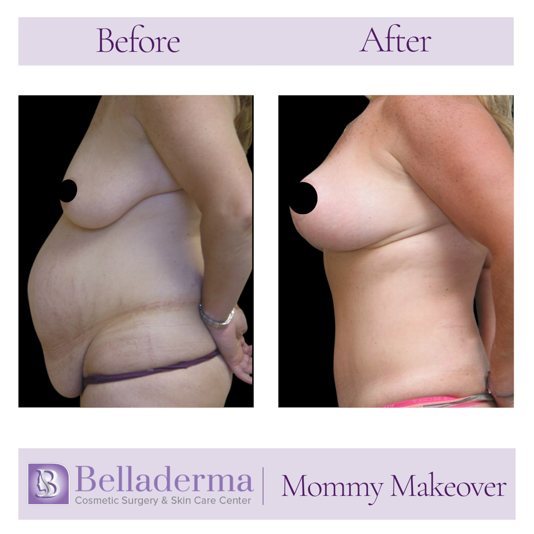 mommy makeover