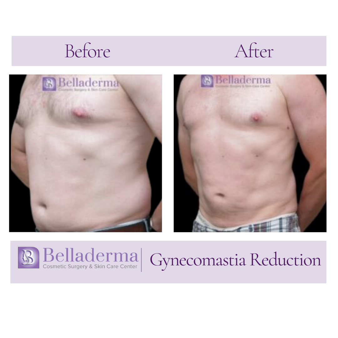 gynecomastia reduction