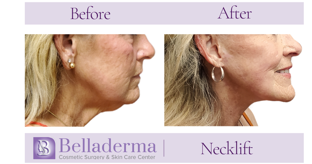 Neck lift