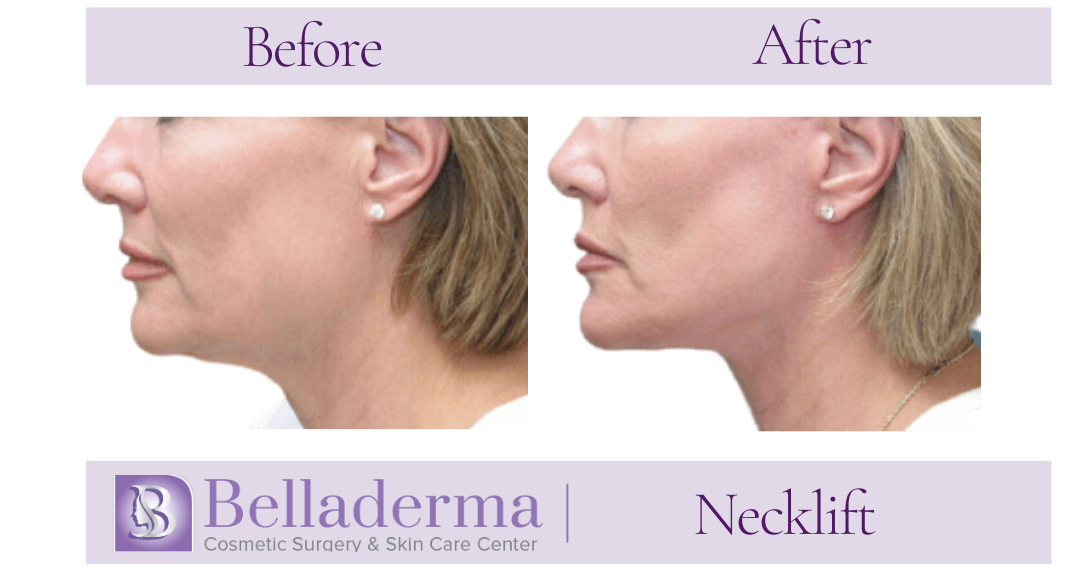 Neck lift