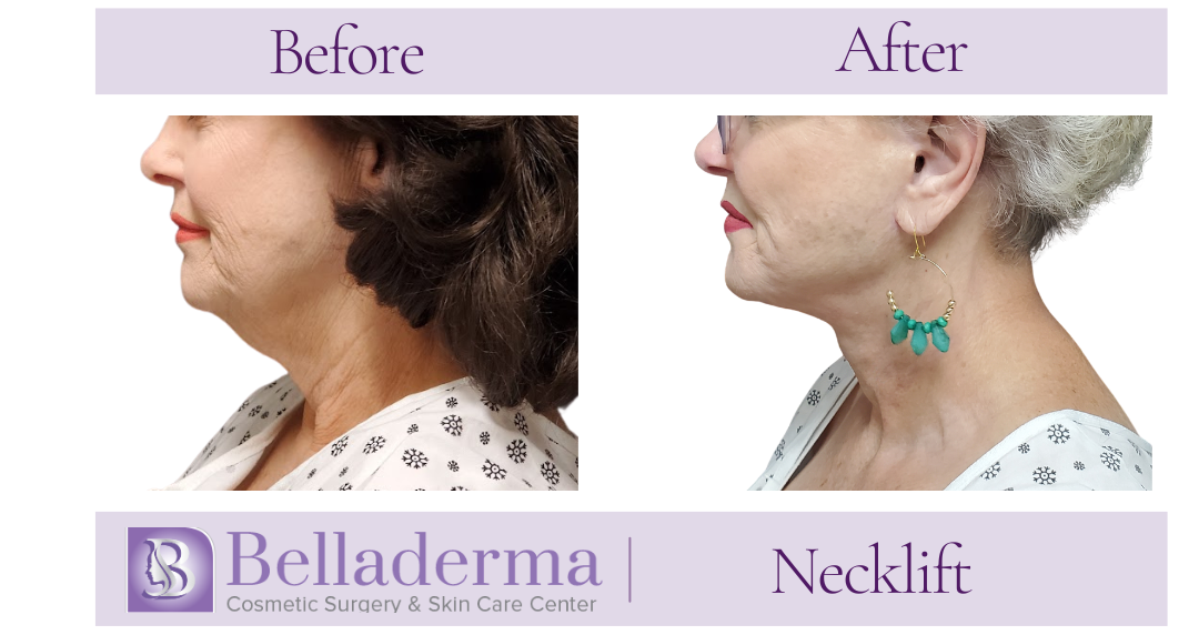 Neck lift